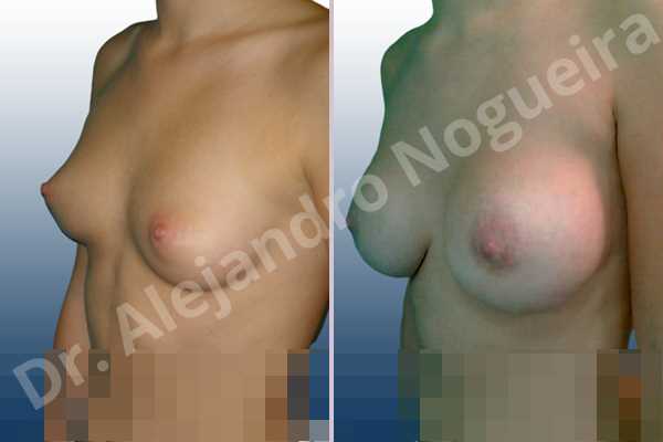 Lateral breasts,Small breasts,Too far apart wide cleavage breasts,Lower hemi periareolar incision,Round shape,Subfascial pocket plane - photo 3