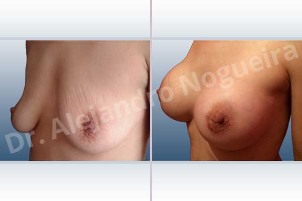 Asymmetric breasts,Empty breasts,Moderately saggy droopy breasts,Narrow breasts,Pendulous breasts,Pigeon chest,Small breasts,Too far apart wide cleavage breasts,Extra large size,Lower hemi periareolar incision,Round shape,Subfascial pocket plane - photo 3