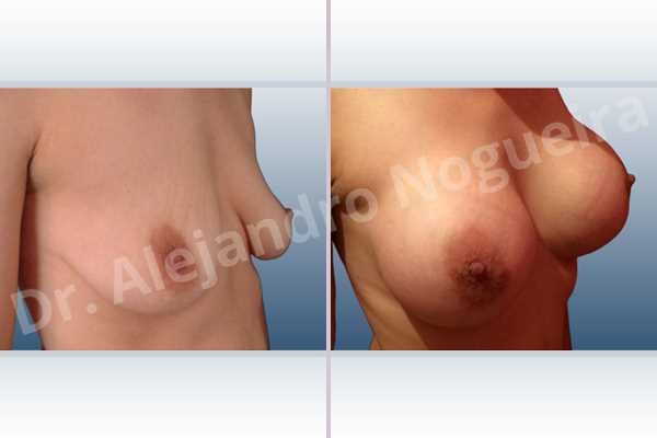 Asymmetric breasts,Empty breasts,Moderately saggy droopy breasts,Narrow breasts,Pendulous breasts,Pigeon chest,Small breasts,Too far apart wide cleavage breasts,Extra large size,Lower hemi periareolar incision,Round shape,Subfascial pocket plane - photo 5