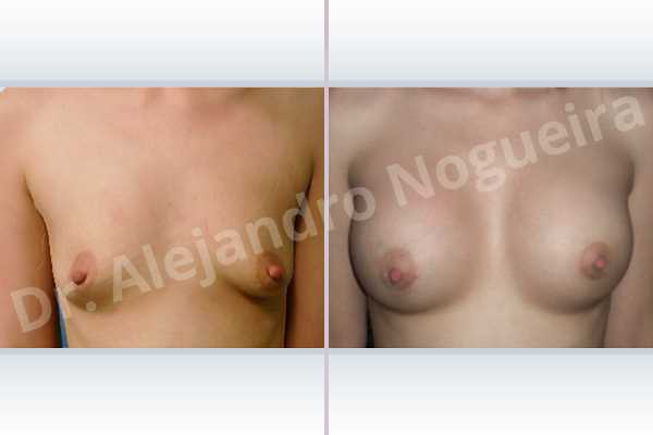 Asymmetric breasts,Empty breasts,Lateral breasts,Narrow breasts,Skinny breasts,Slightly saggy droopy breasts,Small breasts,Too far apart wide cleavage breasts,Tuberous breasts,Lower hemi periareolar incision,Round shape,Subfascial pocket plane,Tuberous mammoplasty - photo 1