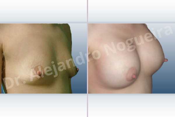 Asymmetric breasts,Empty breasts,Lateral breasts,Narrow breasts,Skinny breasts,Slightly saggy droopy breasts,Small breasts,Too far apart wide cleavage breasts,Tuberous breasts,Lower hemi periareolar incision,Round shape,Subfascial pocket plane,Tuberous mammoplasty - photo 5