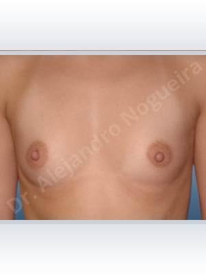 Lateral breasts,Narrow breasts,Skinny breasts,Small breasts,Dual plane pocket,Lower hemi periareolar incision,Round shape
