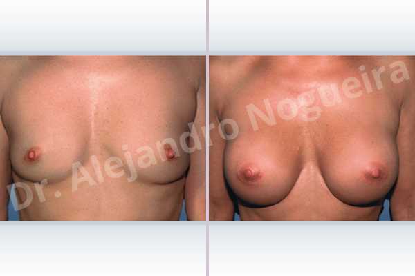 Empty breasts,Mildly saggy droopy breasts,Moderately saggy droopy breasts,Skinny breasts,Small breasts,Wide breasts,Lower hemi periareolar incision,Round shape,Subfascial pocket plane - photo 1