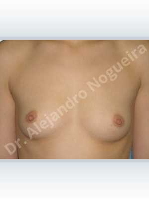 Asymmetric breasts,Cross eyed breasts,Skinny breasts,Small breasts,Lower hemi periareolar incision,Round shape,Subfascial pocket plane