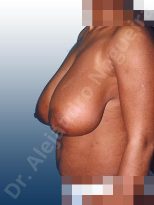 Breast tissue bottoming out,Extremely large breasts,Extremely saggy droopy breasts,Large areolas,Pigmented scars,Tuberous breasts,Anchor incision,Areola reduction,Double vertical pedicle