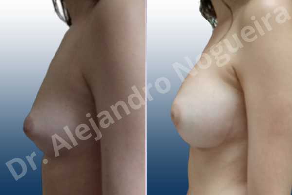 Asymmetric breasts,Cleft nipples,Empty breasts,Inverted nipples,Narrow breasts,Small breasts,Anatomical shape,Circumareolar incision,Extra large size,Subfascial pocket plane - photo 2