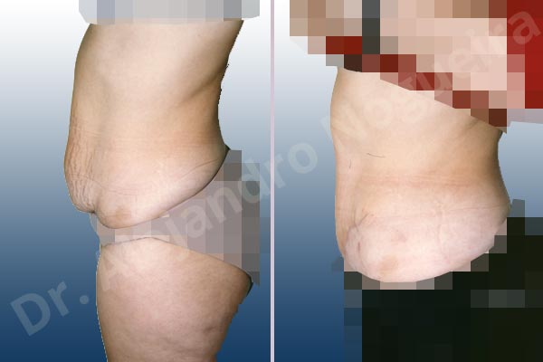 Weak abdomen muscles,Saggy abdomen,Standard abdominoplasty - photo 1