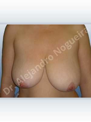Asymmetric breasts,Empty breasts,Extremely saggy droopy breasts,Moderately large breasts,Pendulous breasts,Severely saggy droopy breasts,Wide breasts,Anatomical shape,Anchor incision,Double vertical pedicle,Extra large size,Subfascial pocket plane