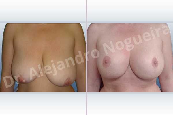 Asymmetric breasts,Empty breasts,Extremely saggy droopy breasts,Moderately large breasts,Pendulous breasts,Severely saggy droopy breasts,Wide breasts,Anatomical shape,Anchor incision,Double vertical pedicle,Extra large size,Subfascial pocket plane - photo 1