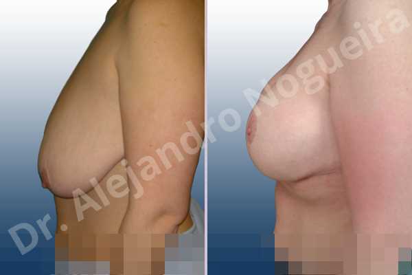 Asymmetric breasts,Empty breasts,Extremely saggy droopy breasts,Moderately large breasts,Pendulous breasts,Severely saggy droopy breasts,Wide breasts,Anatomical shape,Anchor incision,Double vertical pedicle,Extra large size,Subfascial pocket plane - photo 2