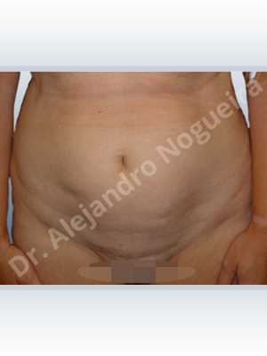 Saggy abdomen,Sunken scars,Weak abdomen muscles,Standard abdominoplasty