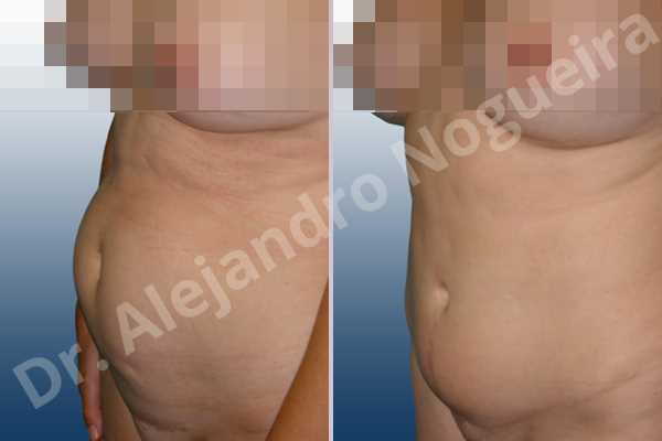 Saggy abdomen,Sunken scars,Weak abdomen muscles,Standard abdominoplasty - photo 3