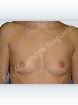 Asymmetric breasts,Skinny breasts,Small breasts,Anatomical shape,Lower hemi periareolar incision,Subfascial pocket plane