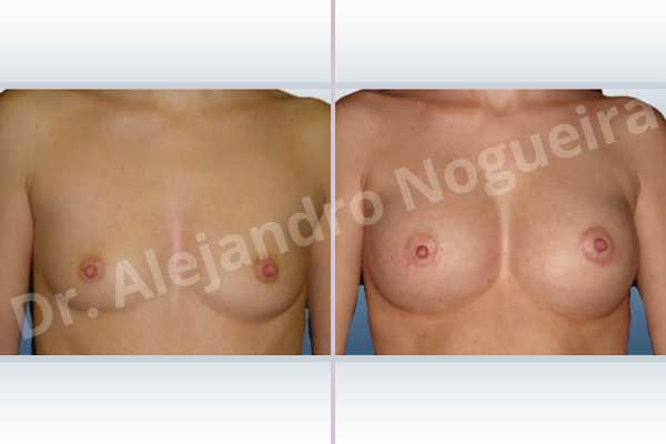 Asymmetric breasts,Skinny breasts,Small breasts,Anatomical shape,Lower hemi periareolar incision,Subfascial pocket plane - photo 1