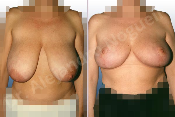 Breast tissue bottoming out,Extremely saggy droopy breasts,Large areolas,Moderately large breasts,Pendulous breasts,Tuberous breasts,Anchor incision,Areola reduction,Double vertical pedicle - photo 1