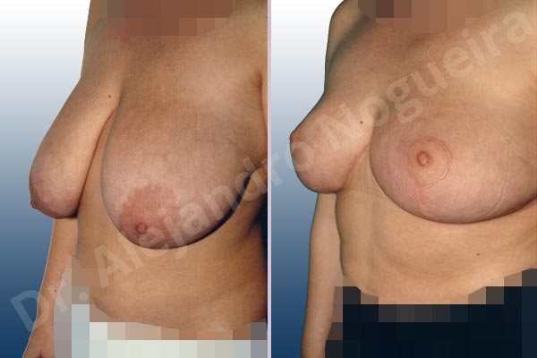 Breast tissue bottoming out,Extremely saggy droopy breasts,Large areolas,Moderately large breasts,Pendulous breasts,Tuberous breasts,Anchor incision,Areola reduction,Double vertical pedicle - photo 2