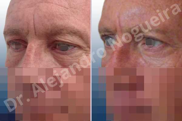 Baggy lower eyelids,Saggy upper eyelids,Upper eyelids ptosis,Lower eyelid fat bags resection,Transconjunctival approach incision,Upper eyelid skin and muscle resection - photo 3