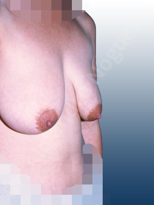 Severely saggy droopy breasts,Tuberous breasts,Lollipop incision,Superior pedicle