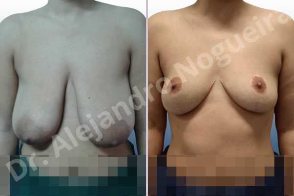 Asymmetric breasts,Empty breasts,Extremely saggy droopy breasts,Large areolas,Moderately large breasts,Pendulous breasts,Wide breasts,Tuberous breasts,Anchor incision,Areola reduction,Double vertical pedicle - photo 1