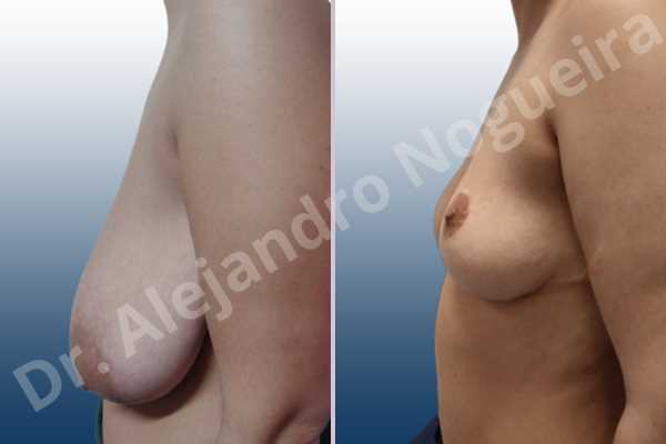 Asymmetric breasts,Empty breasts,Extremely saggy droopy breasts,Large areolas,Moderately large breasts,Pendulous breasts,Wide breasts,Tuberous breasts,Anchor incision,Areola reduction,Double vertical pedicle - photo 2