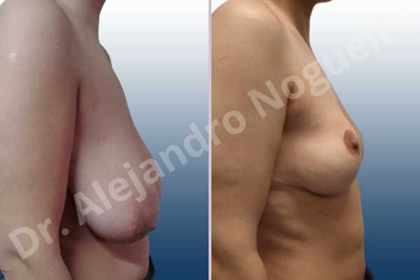 Asymmetric breasts,Empty breasts,Extremely saggy droopy breasts,Large areolas,Moderately large breasts,Pendulous breasts,Wide breasts,Tuberous breasts,Anchor incision,Areola reduction,Double vertical pedicle - photo 4