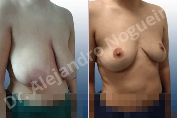 Asymmetric breasts,Empty breasts,Extremely saggy droopy breasts,Large areolas,Moderately large breasts,Pendulous breasts,Wide breasts,Tuberous breasts,Anchor incision,Areola reduction,Double vertical pedicle - photo 5