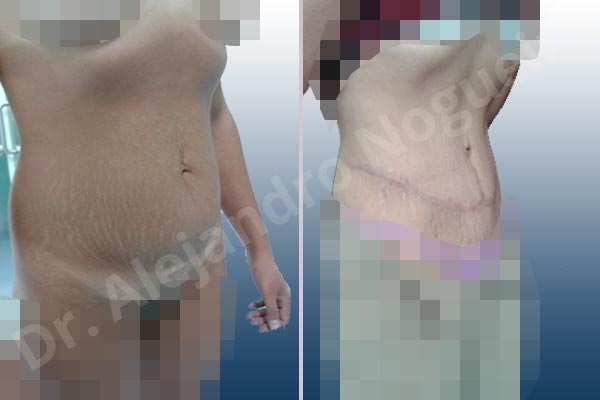 Saggy abdomen,Weak abdomen muscles,Standard abdominoplasty - photo 10