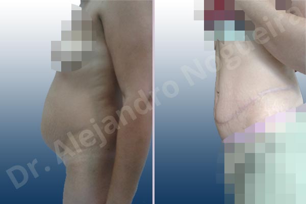Saggy abdomen,Weak abdomen muscles,Standard abdominoplasty - photo 3