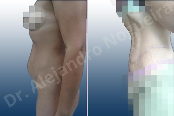 Saggy abdomen,Weak abdomen muscles,Standard abdominoplasty - photo 4