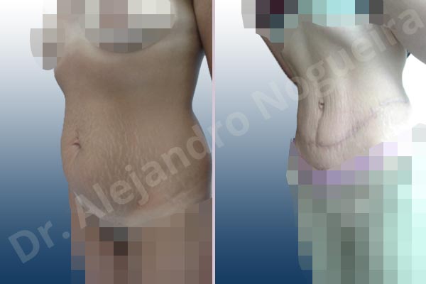 Saggy abdomen,Weak abdomen muscles,Standard abdominoplasty - photo 6