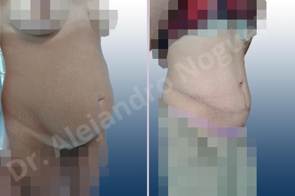 Saggy abdomen,Weak abdomen muscles,Standard abdominoplasty - photo 9