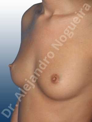 Small breasts,Wide breasts,Anatomical shape,Inframammary incision,Subfascial pocket plane
