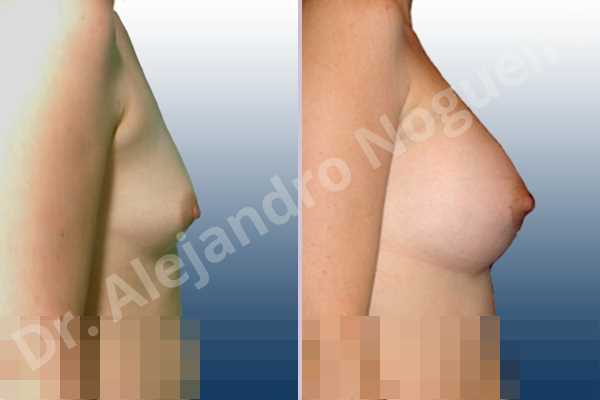 Asymmetric breasts,Cross eyed breasts,Small breasts,Anatomical shape,Lower hemi periareolar incision,Subfascial pocket plane - photo 4