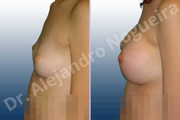 Asymmetric breasts,Cross eyed breasts,Lateral breasts,Narrow breasts,Skinny breasts,Sunken chest,Too far apart wide cleavage breasts,Lower hemi periareolar incision,Round shape,Subfascial pocket plane - photo 2