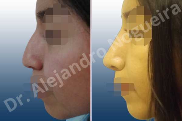 Alar rim retraction,Andine nose,Asymmetric tip,Broad nose,Bulbous tip,Crooked tip,Dorsum hump,Dorsum ridges,Droopy tip,Poorly defined tip,Poorly supported tip,Short nose,Short septum,Short upper lateral cartilages,Small nose,Sunken columella,Tension nose,Thick skin nose,Underprojected tip,Columella strut graft,Custom made tip graft,Dorsum hump resection,Ear cartilage graft harvesting,Extended columella strut graft,Extended shield tip columella graft,Intercrural columella plasty sutures,Interdomal tip plasty sutures,Lateral cruras batten graft,Lateral cruras caudal extension graft,Lateral cruras cephalic resection,Lateral cruras repositioning,Nasal bones osteotomies,Onlay tip graft,Open approach incision,Septal cartilage graft harvesting,Septum caudal extension graft,Septum replacement graft,Shield tip graft,Tip defatting,Tip replacement graft,Tongue in groove columella setback,Transdomal tip plasty scoring,Transdomal tip plasty sutures,Triangular cartilages caudal extension graft - photo 2