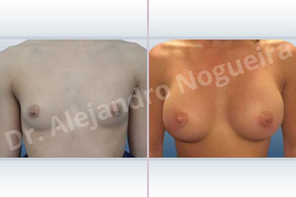 Empty breasts,Lateral breasts,Narrow breasts,Skinny breasts,Small breasts,Too far apart wide cleavage breasts,Anatomical shape,Circumareolar incision,Subfascial pocket plane - photo 1