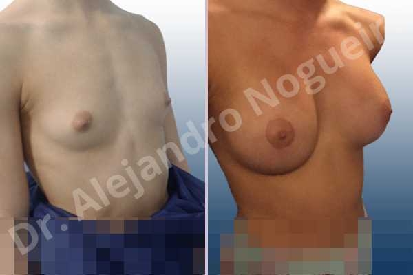Empty breasts,Lateral breasts,Narrow breasts,Skinny breasts,Small breasts,Too far apart wide cleavage breasts,Anatomical shape,Circumareolar incision,Subfascial pocket plane - photo 5