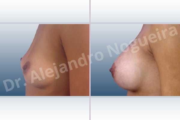 Asymmetric breasts,Empty breasts,Slightly saggy droopy breasts,Small breasts,Anatomical shape,Lower hemi periareolar incision,Subfascial pocket plane - photo 2