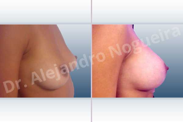Asymmetric breasts,Empty breasts,Slightly saggy droopy breasts,Small breasts,Anatomical shape,Lower hemi periareolar incision,Subfascial pocket plane - photo 4