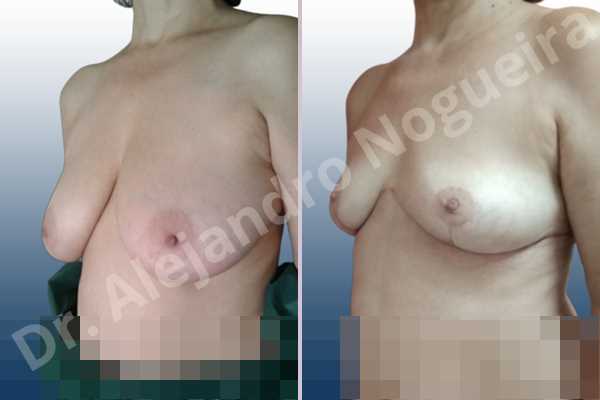 Asymmetric breasts,Large areolas,Moderately large breasts,Pendulous breasts,Pigeon chest,Severely saggy droopy breasts,Wide breasts,Anchor incision,Double vertical pedicle,Areola reduction - photo 3