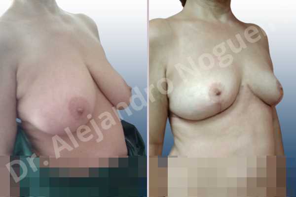 Asymmetric breasts,Large areolas,Moderately large breasts,Pendulous breasts,Pigeon chest,Severely saggy droopy breasts,Wide breasts,Anchor incision,Double vertical pedicle,Areola reduction - photo 5