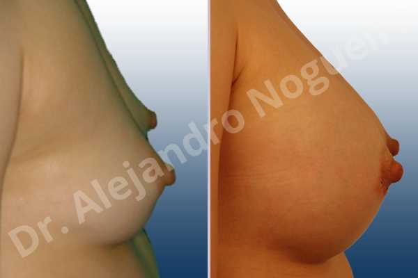 Narrow breasts,Skinny breasts,Anatomical shape,Lower hemi periareolar incision,Subfascial pocket plane - photo 3