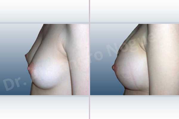 Asymmetric breasts,Cross eyed breasts,Lateral breasts,Narrow breasts,Skinny breasts,Small breasts,Too far apart wide cleavage breasts,Anatomical shape,Lower hemi periareolar incision,Subfascial pocket plane - photo 2
