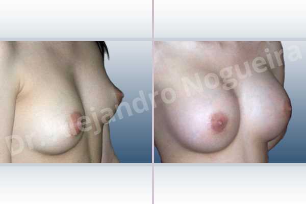 Asymmetric breasts,Cross eyed breasts,Lateral breasts,Narrow breasts,Skinny breasts,Small breasts,Too far apart wide cleavage breasts,Anatomical shape,Lower hemi periareolar incision,Subfascial pocket plane - photo 5