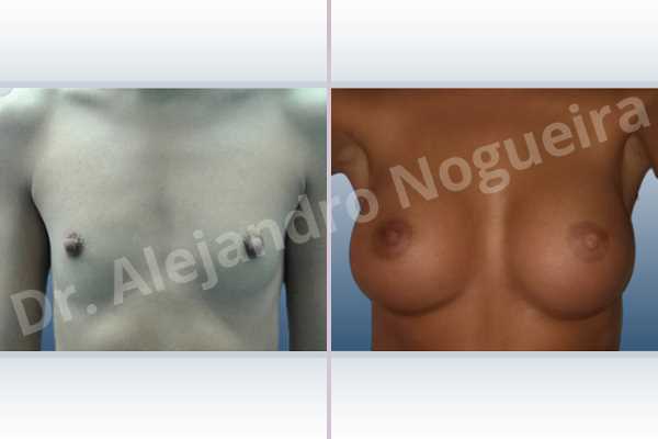 Cross eyed breasts,Empty breasts,Lateral breasts,Narrow breasts,Skinny breasts,Small breasts,Anatomical shape,Inframammary incision,Subfascial pocket plane - photo 1