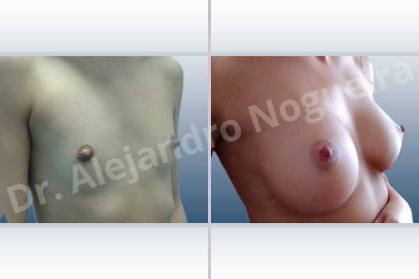 Cross eyed breasts,Empty breasts,Lateral breasts,Narrow breasts,Skinny breasts,Small breasts,Anatomical shape,Inframammary incision,Subfascial pocket plane - photo 5