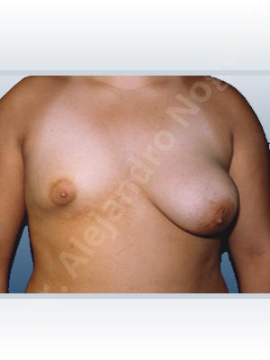 Asymmetric breasts,Empty breasts,Large areolas,Lateral breasts,Pendulous breasts,Severely saggy droopy breasts,Small breasts,Too far apart wide cleavage breasts,Tuberous breasts,Areola reduction,Dual plane pocket,Lollipop incision,Lower hemi periareolar incision,Round shape,Superior pedicle,Tuberous mammoplasty