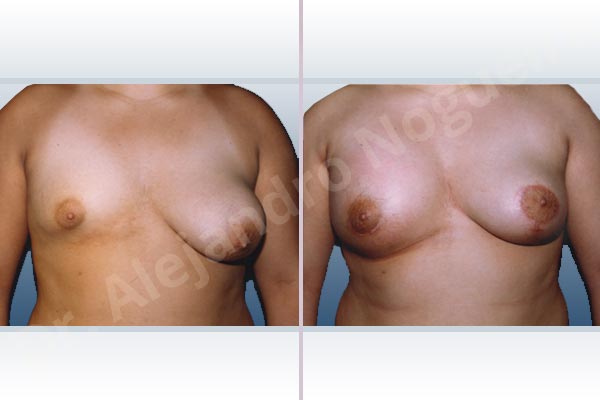 Asymmetric breasts,Empty breasts,Large areolas,Lateral breasts,Pendulous breasts,Severely saggy droopy breasts,Small breasts,Too far apart wide cleavage breasts,Tuberous breasts,Areola reduction,Dual plane pocket,Lollipop incision,Lower hemi periareolar incision,Round shape,Superior pedicle,Tuberous mammoplasty - photo 1