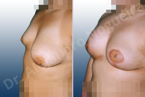 Asymmetric breasts,Empty breasts,Large areolas,Lateral breasts,Pendulous breasts,Severely saggy droopy breasts,Small breasts,Too far apart wide cleavage breasts,Tuberous breasts,Areola reduction,Dual plane pocket,Lollipop incision,Lower hemi periareolar incision,Round shape,Superior pedicle,Tuberous mammoplasty - photo 2