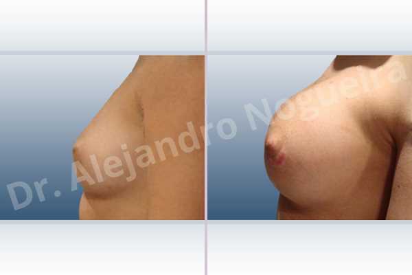 Narrow breasts,Slightly large breasts,Custom made size and shape,Lower hemi periareolar incision,Round shape,Subfascial pocket plane,Extra large size - photo 2